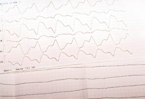 Asystole: Definition, Causes,