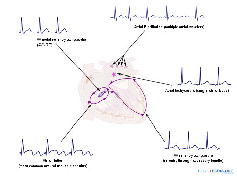 465px-SVT_overview_CardioNetworks_ECGpediasvg