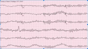 Ventricular Fibrillation