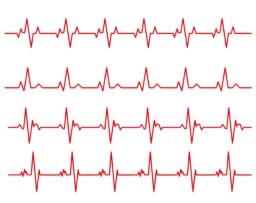 Monomorphic & Polymorphic Ventricular Tachycardias