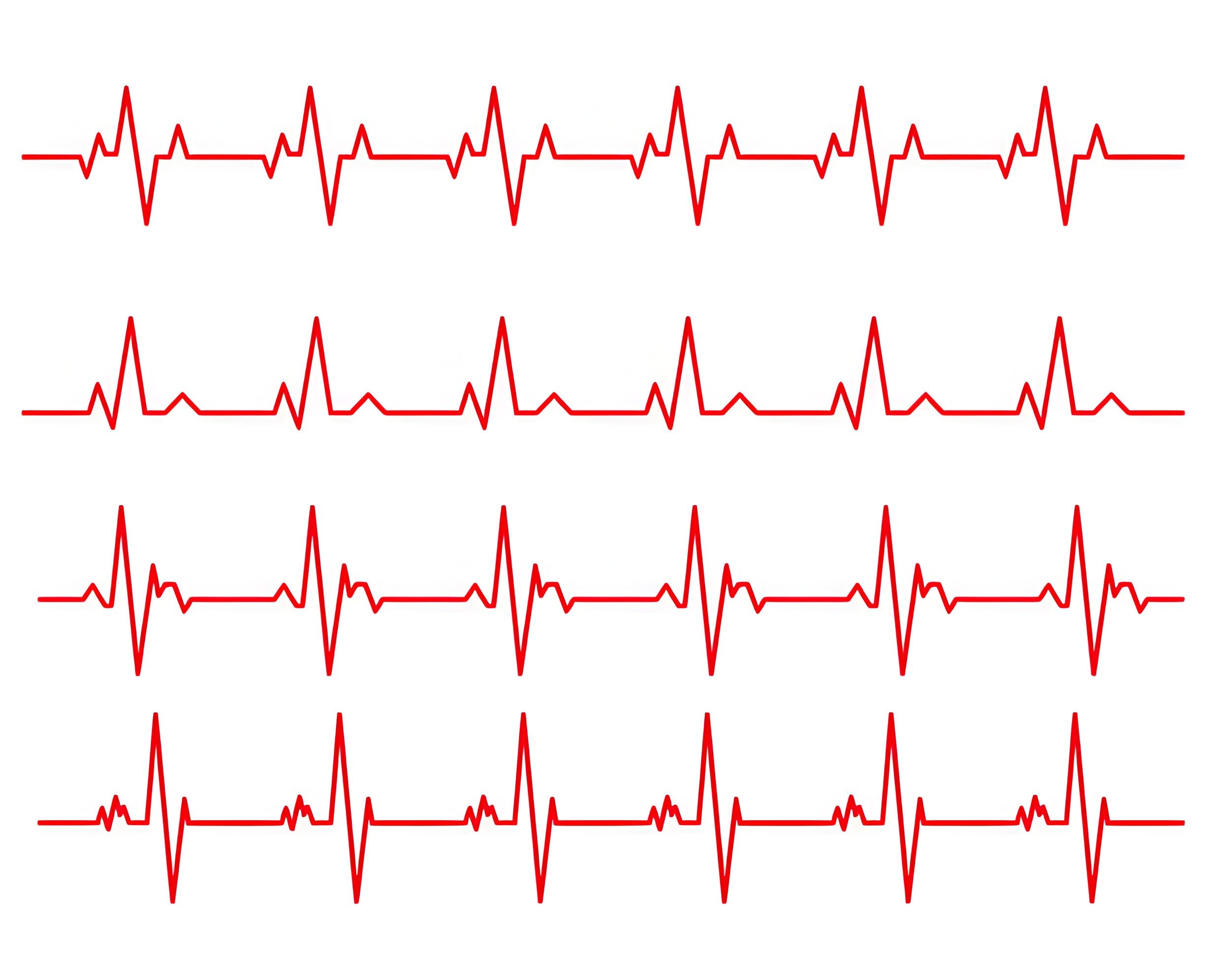 Monomorphic & Polymorphic Ventricular Tachycardias