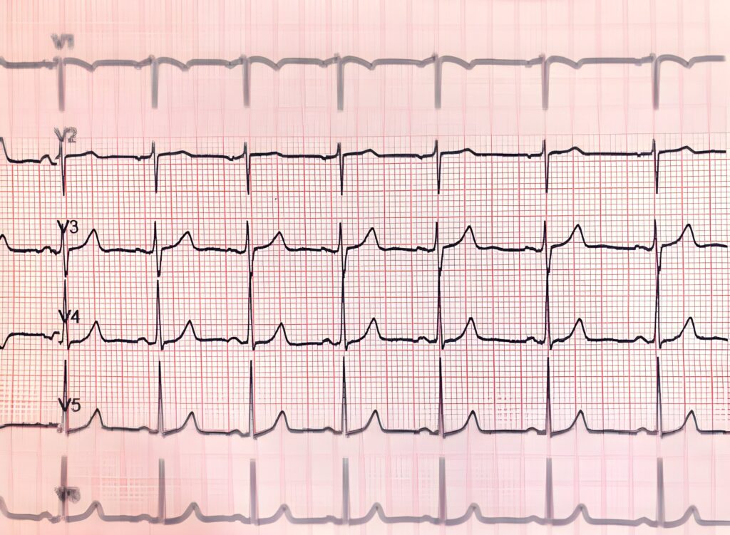 Saving Lives: Understanding and Treating Pulseless Ventricular ...