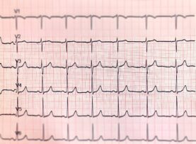 Pulseless Ventricular Tachycardia (VT)