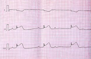 Identifying and Treating First-Degree AV Block