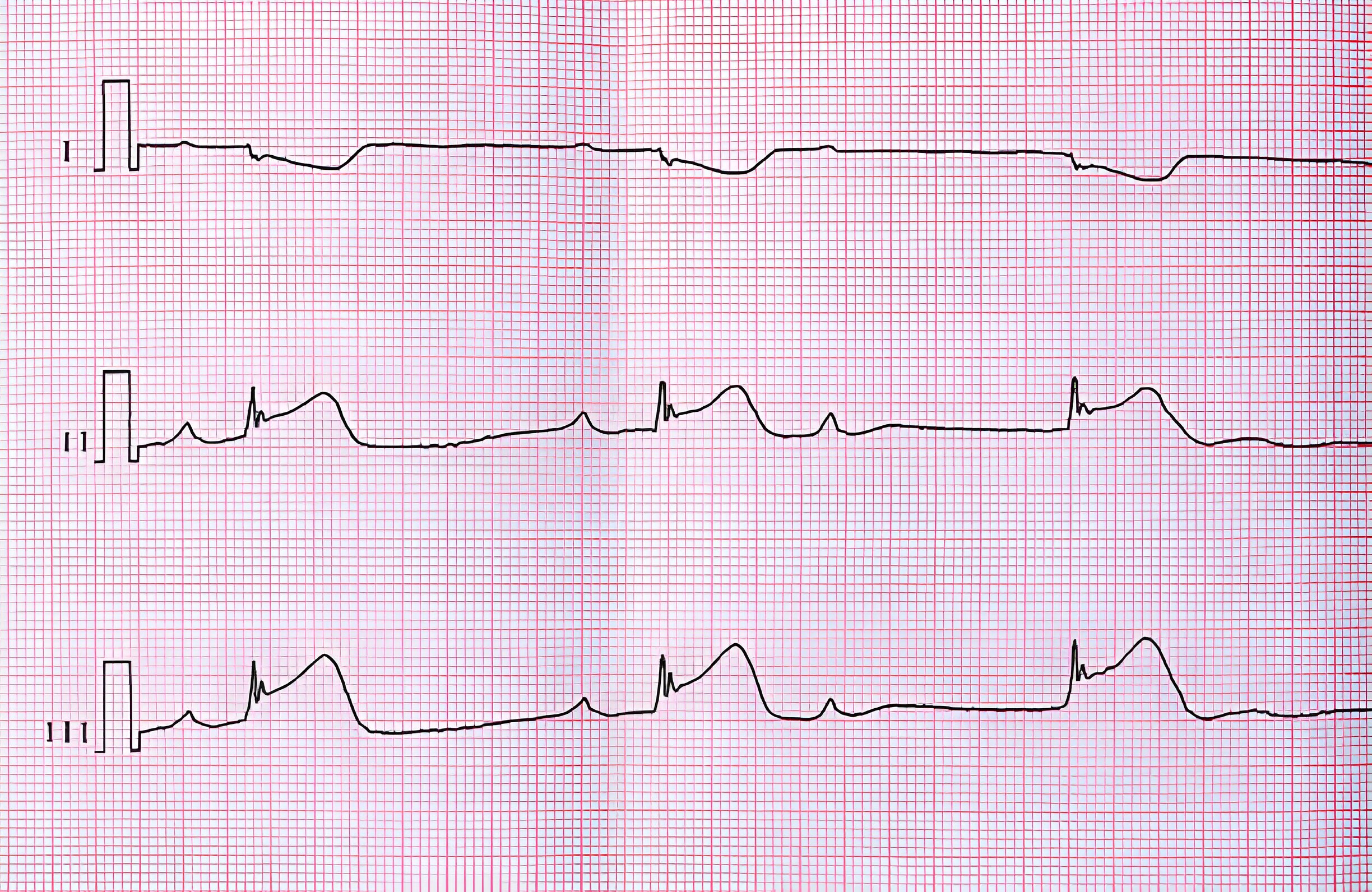 Identifying and Treating First-Degree AV Block