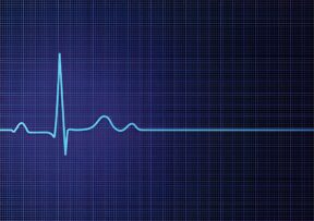 SVT vs. VT: Differences in Heart Rhythm