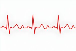 Sinus Bradycardia