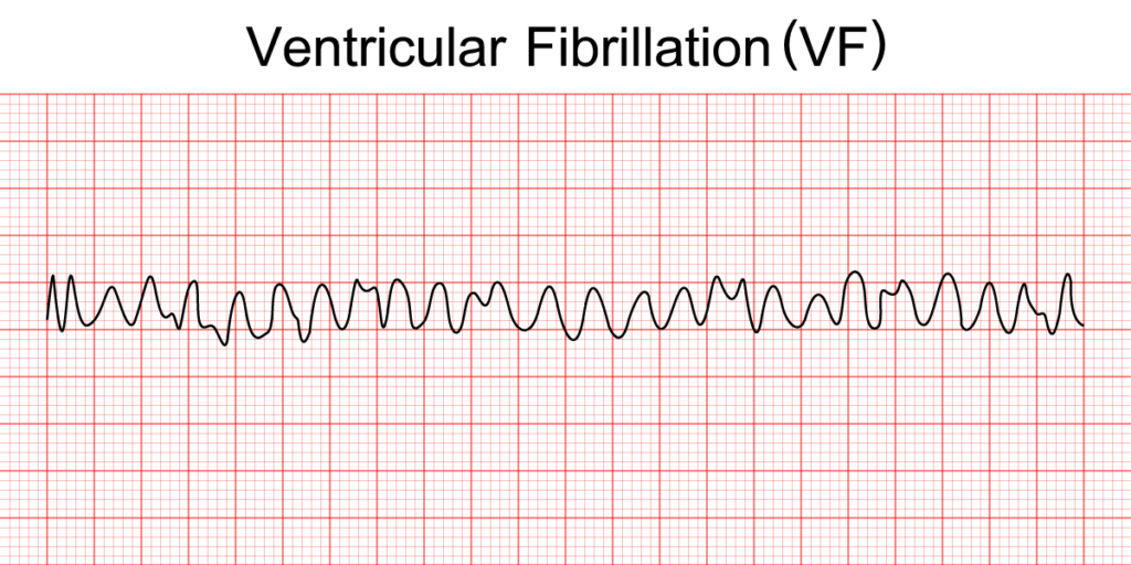 ventricular fibrillation