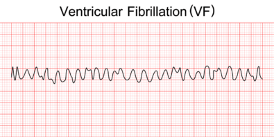 ventricular fibrillation